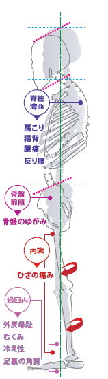 足の歪みが全身に連鎖する図