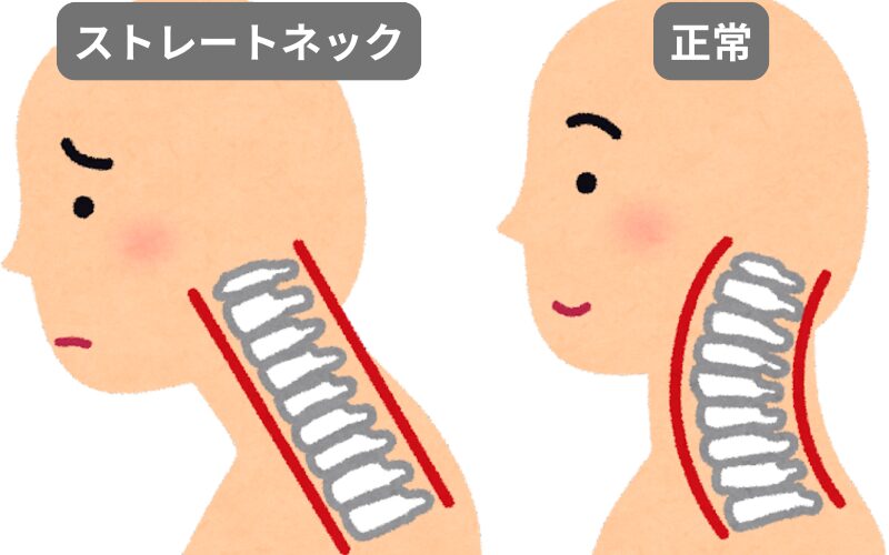 ストレートネックと正常な首の骨の比較